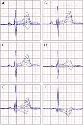 Heart Rate Dependency and Inter-Lead Variability of the T Peak – T End Intervals